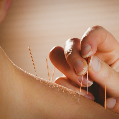 Acupuncture